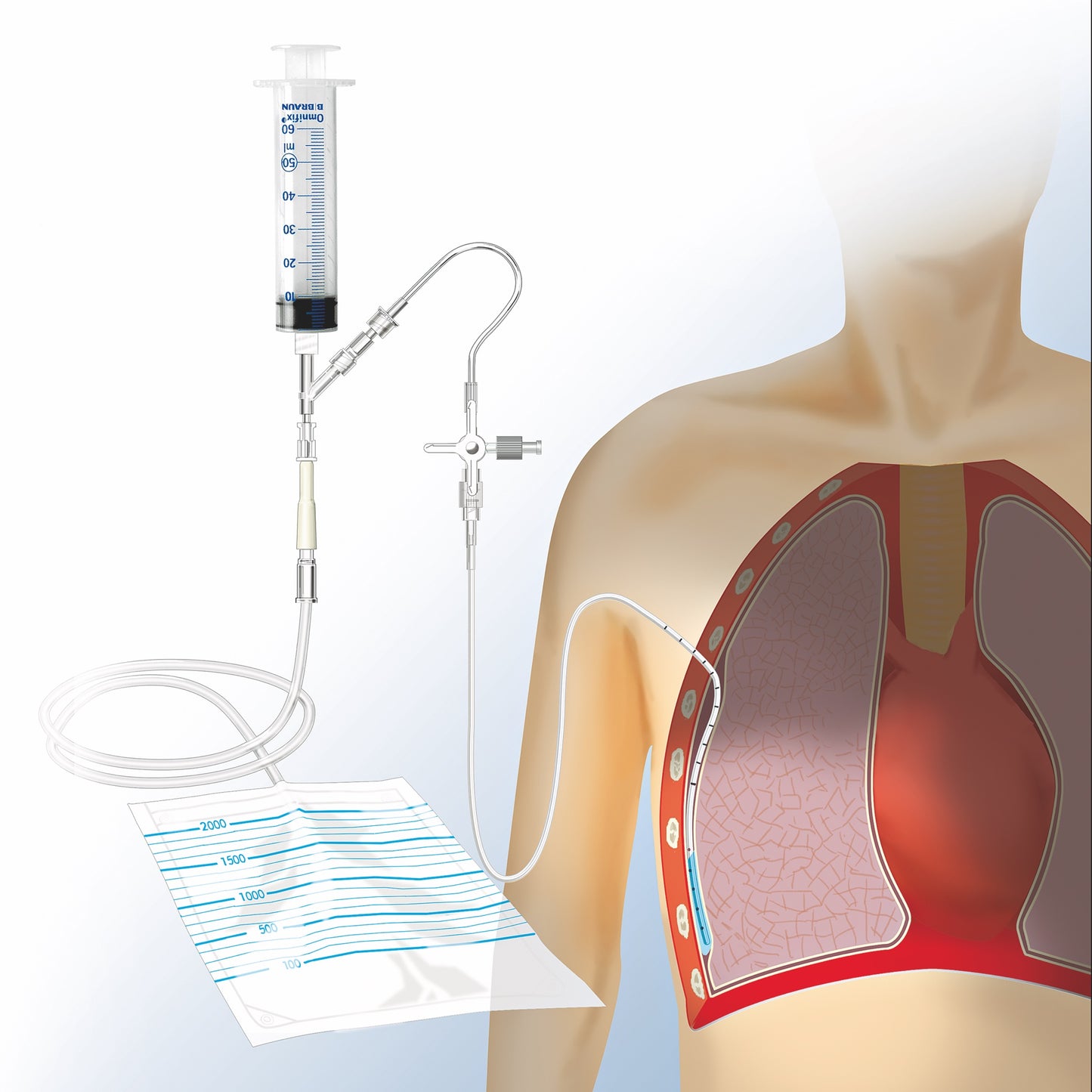 Pleura-und Thoraxdrainage-  Set Komplett-Set nach Matthys